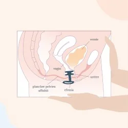 Efemia Pessaire Fuite Urinaire