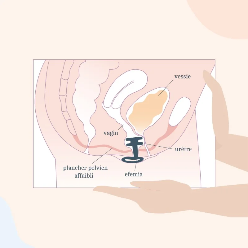 Efemia Pessaire Fuite Urinaire
